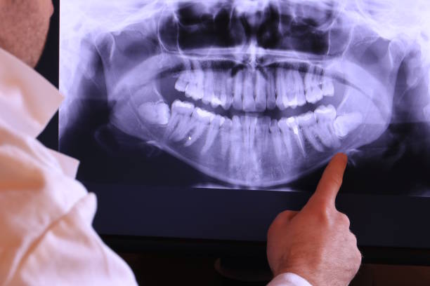 Best Emergency Wisdom Tooth Extraction in Parkston, SD